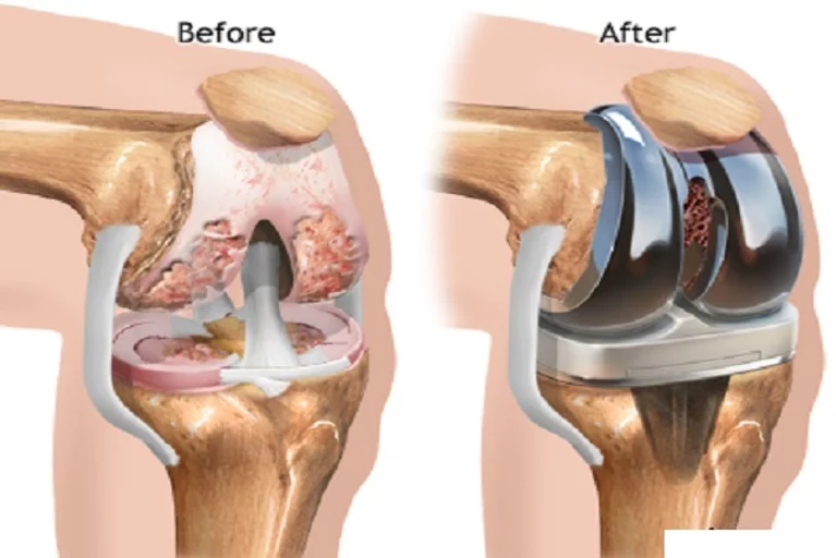 knee-surgery